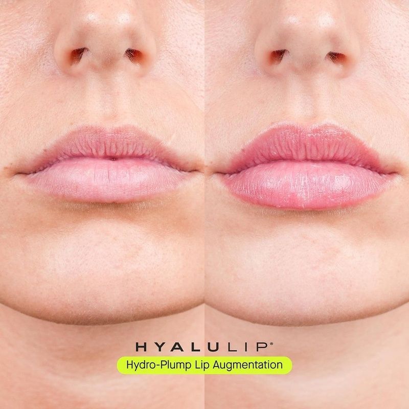Засіб для ефекту збільшення губ HYALULIP VOLUME (Hydro-Plump Lip Augmentation), 15 мл 46576879888 фото Засіб для ефекту збільшення губ HYALULIP VOLUME (Hydro-Plump Lip Augmentation), 15 мл 46576879888 фото