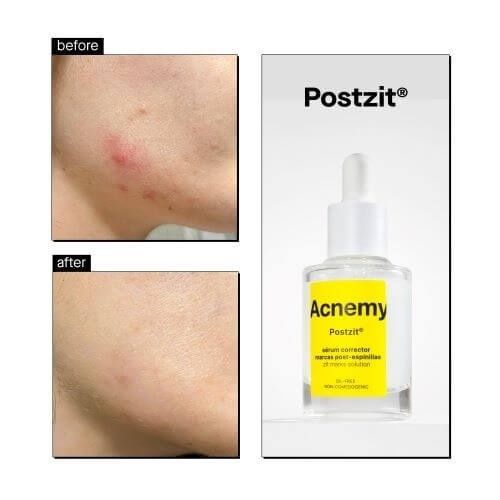 Сироватка від висипань Acnemy POSTZIT, 10 мл 43201/М фото